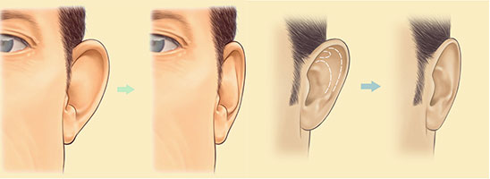 Principle-Otoplasty-Surgery-Protruding-ears-Tunisia
